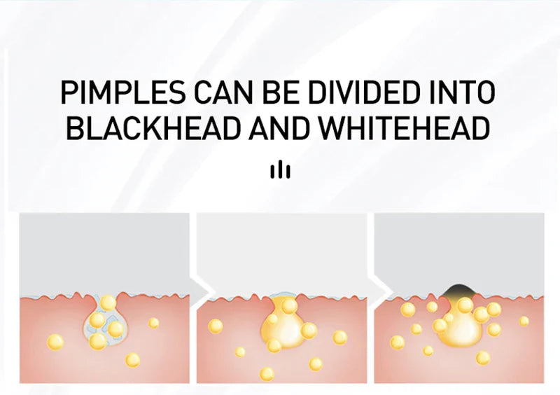 AUQUEST Acne Face Cream Salicylic Acid Oil Control Whitening Shrink Pores Beauty Health Korean Cosmetics Skin Care