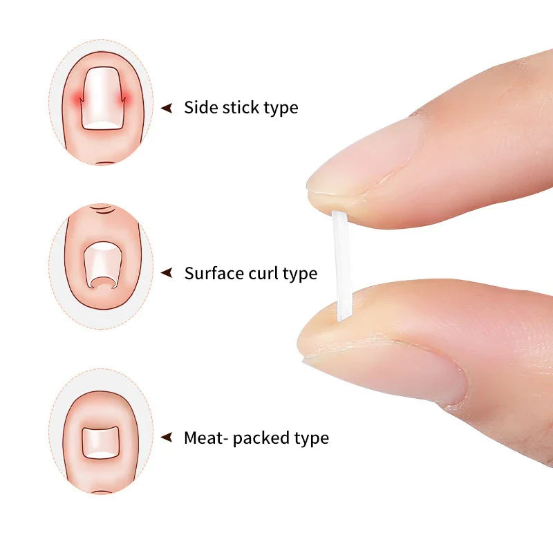 50Pcs Ingrown Toenail Correction Tool Ingrown Toe Nail Treatment Elastic Patch Sticker Straightening Clip Brace Pedicure Tool