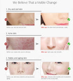 ARTISCARE Vitamin C Serum for Face Moisturizing 4Pcs Hyaluron Acid Facial Care Nourishing Essence SkinCare Products