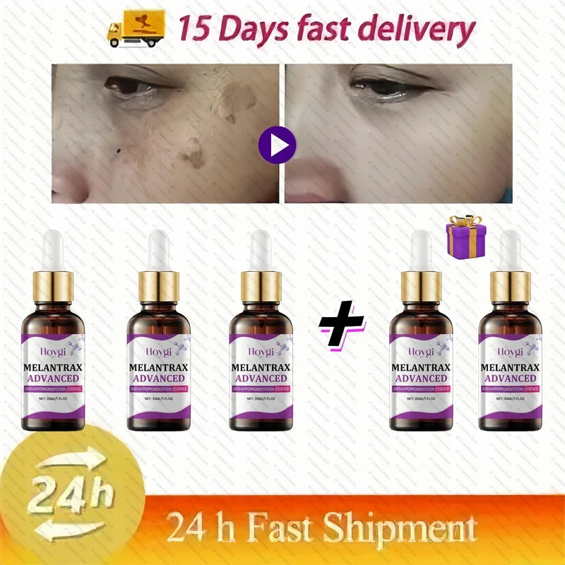 Dark Spots Remover Whitening Serum Face Freckle Melanin Correcting Anti Pigmentation Brighten Beauty Korean Day Night Skin Care