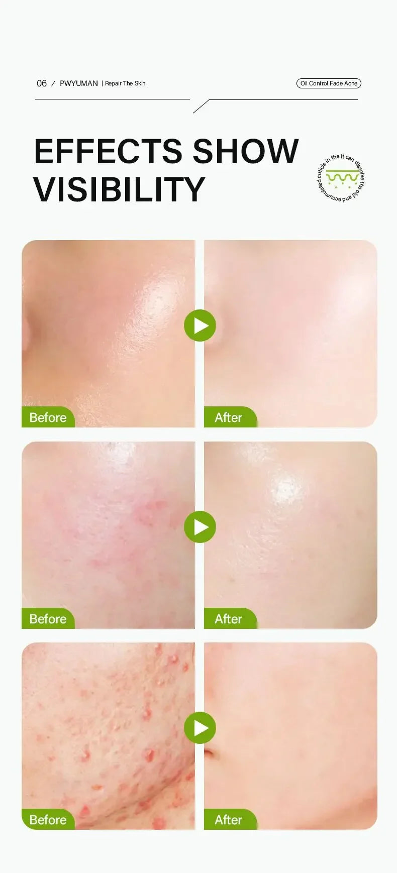 Acidity Pore Shrink Face Serum Remove Blackheads Acne Oil Control Repair Essence Moisturizing Nourish Pores Firming Facial Care