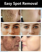 Dark Spots Remover Whitening Serum Face Freckle Melanin Correcting Anti Pigmentation Brighten Beauty Korean Day Night Skin Care