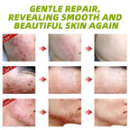 30g Acne Cream soothes, hydrates, helps regulate oil, reduces redness, and enhances skin texture with a moisturizing feel