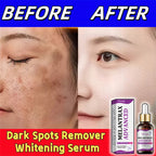 Dark Spots Remover Whitening Serum Face Freckle Melanin Correcting Anti Pigmentation Brighten Beauty Korean Day Night Skin Care