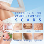 4x15cm 3pcs Silicone Scar sheet Self-Adhesive Scar Cover Tape Scalable for Burn Injury C-Section Keloid Skin Care