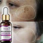 Dark Spots Remover Whitening Serum Face Freckle Melanin Correcting Anti Pigmentation Brighten Beauty Korean Day Night Skin Care